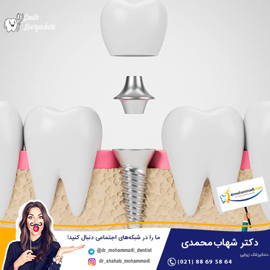 علائم پس زدن ایمپلنت چیست و چرا ایمپلنت دندان شکست می خورد - کلینیک دندانپزشکی دکتر شهاب محمدی